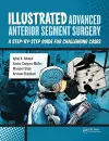 Illustrated Advanced Anterior Segment Surgery cover