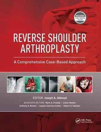 Reverse Shoulder Arthroplasty cover