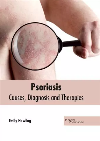 Psoriasis: Causes, Diagnosis and Therapies cover