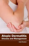 Atopic Dermatitis: Disease and Management cover