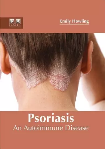 Psoriasis: An Autoimmune Disease cover