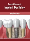 Recent Advances in Implant Dentistry cover