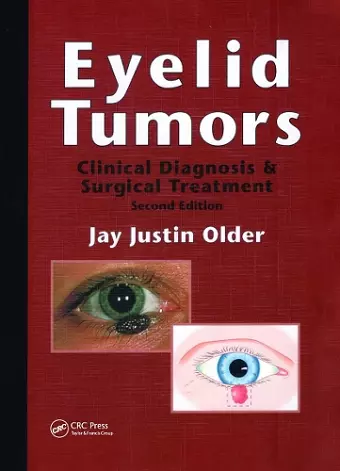 Eyelid Tumors cover