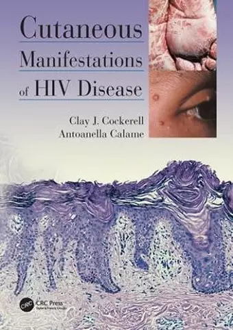 Cutaneous Manifestations of HIV Disease cover