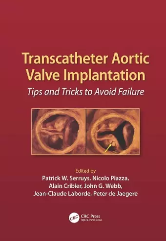 Transcatheter Aortic Valve Implantation cover