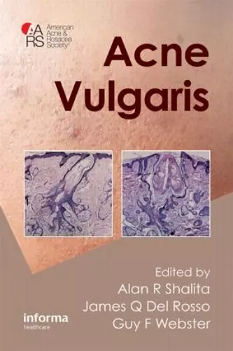 Acne Vulgaris cover