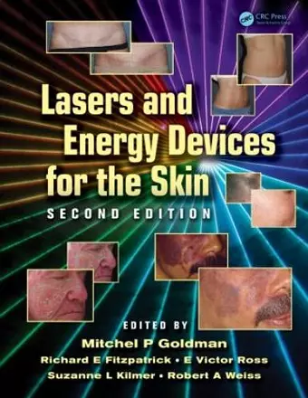 Lasers and Energy Devices for the Skin cover