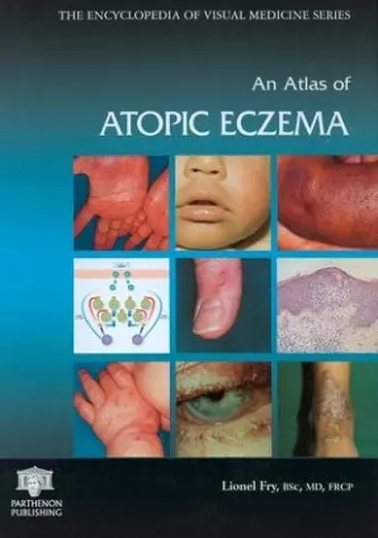 An Atlas of Atopic Eczema cover