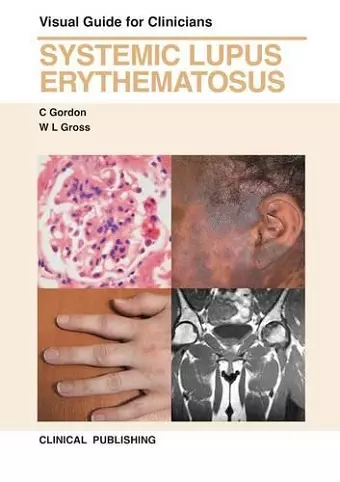 Systemic Lupus Erythematosus cover