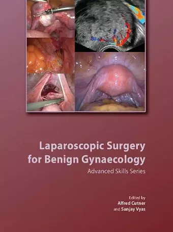 Laparoscopic Surgery for Benign Gynaecology Hardback with DVDs cover