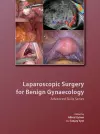 Laparoscopic Surgery for Benign Gynaecology Hardback with DVDs cover