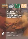 Cosmetic Surgery after Massive Weight Loss cover