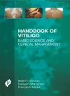 Handbook of Vitiligo cover