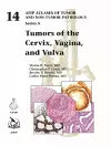 Tumors of the Cervix, Vagina, and Vulva cover