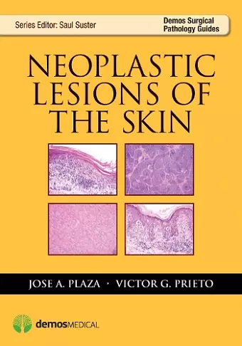 Neoplastic Lesions of the Skin cover