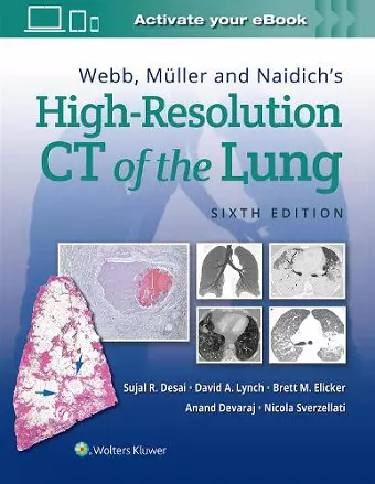 Webb, Müller and Naidich's High-Resolution CT of the Lung cover