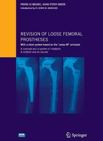 Revision of loose femoral prostheses with a stem system based on the "press-fit" principle cover