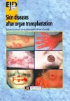 Skin Diseases After Organ Transplantation cover