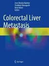 Colorectal Liver Metastasis cover