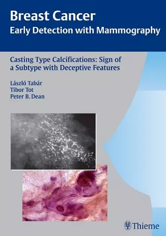 Casting-Type Calcifications: Sign of a Subtype with Deceptive Features cover