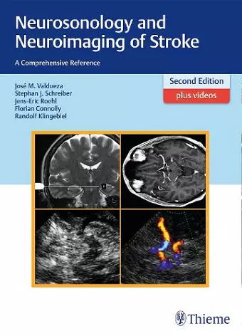 Neurosonology and Neuroimaging of Stroke cover