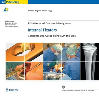AO Manual of Fracture Management: Internal Fixators cover