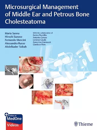 Microsurgical Management of Middle Ear and Petrous Bone Cholesteatoma cover