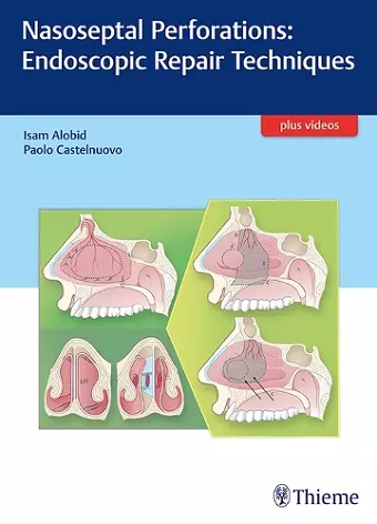 Nasoseptal Perforations: Endoscopic Repair Techniques cover