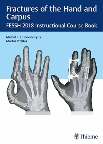 Fractures of the Hand and Carpus cover