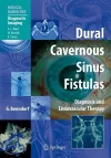 Dural Cavernous Sinus Fistulas cover