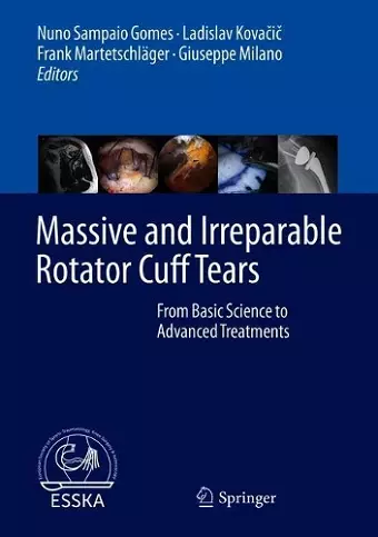 Massive and Irreparable Rotator Cuff Tears cover