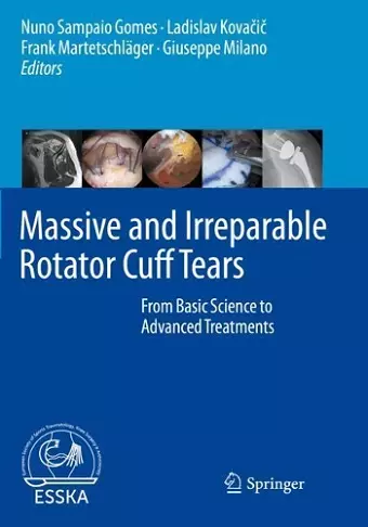 Massive and Irreparable Rotator Cuff Tears cover