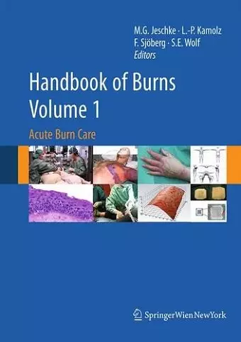 Handbook of Burns Volume 1 cover