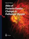 Atlas of Posterior Fundus Changes in Pathologic Myopia cover