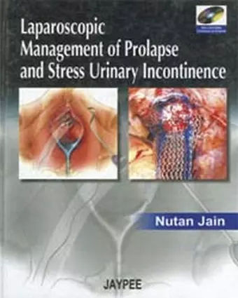 Laparoscopic Management of Prolapse and Stress Urinary Incontinence cover