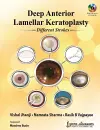 Deep Anterior Lamellar Keratoplasty Different Strokes cover
