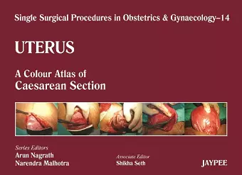 Single Surgical Procedures in Obstetrics and Gynaecology - Volume 14 - Uterus cover