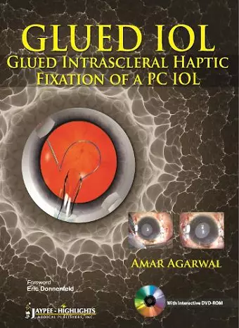 GLUED IOL cover