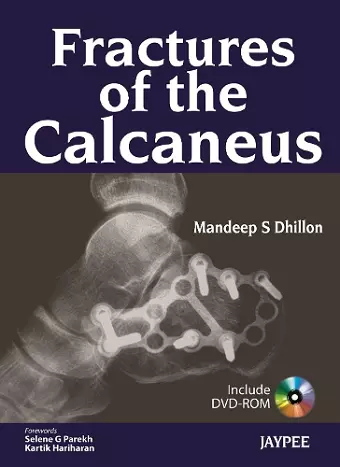 Fractures of the Calcaneus cover