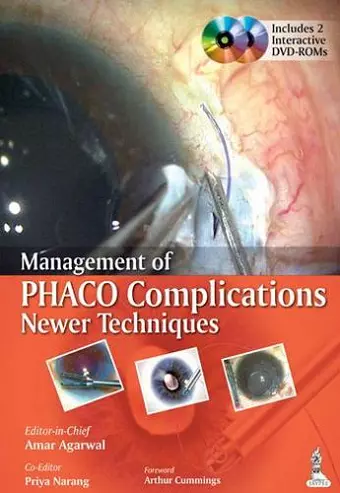 Management of Phaco Complications cover