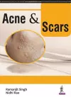 Acne & Scars cover