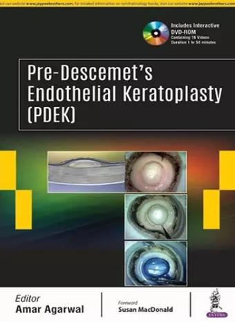 Pre-Descemet’s Endothelial Keratoplasty (PDEK) cover