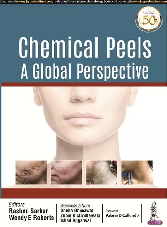 Chemical Peels: A Global Perspective cover