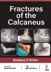 Fractures of the Calcaneus cover