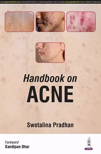 Handbook on Acne cover