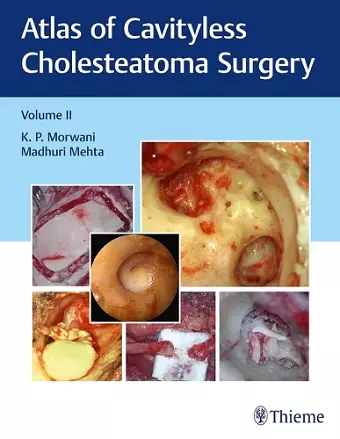 Atlas of Cavityless Cholesteatoma Surgery, Vol 2 cover
