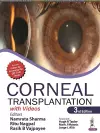 Corneal Transplantation cover
