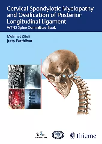 Cervical Spondylotic Myelopathy and Ossification of Posterior Longitudinal Ligament cover