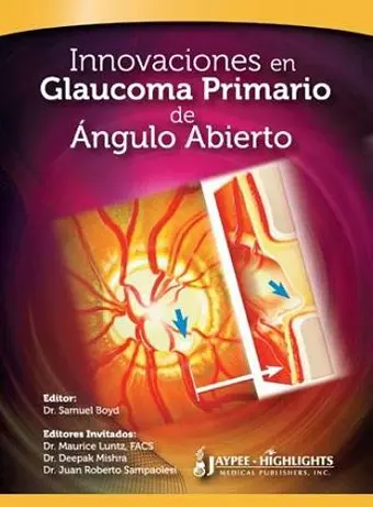 Innovaciones en Glaucoma Primario de Ángulo Abierto cover